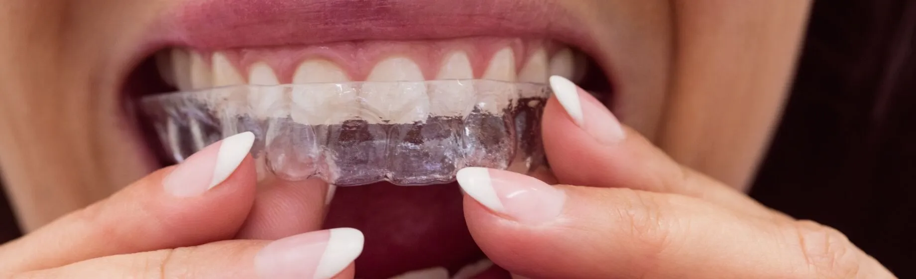 Invisalign® Adult Treatment In Roanoke, VA